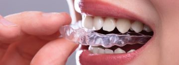 In-Line® Invisible Braces – Hartley Dental Practice